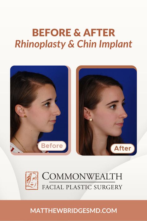 Stunning results with this beautiful, young patient who complained of bump on her profile as well as drooping of the tip! 👃 She was noted to have a recessed chin, which caused her profile to be further out of balance. After a closed (scarless) rhinoplasty and chin implant, her profile balance is improved and she has better definition of her tip. Another happy patient! 👏 #rhinoplasty # Recessed Chin, Closed Rhinoplasty, Chin Augmentation, Chin Implant, Rhinoplasty Before And After, Facial Plastic Surgery, Facial Plastic, Before After Photo, After Photos