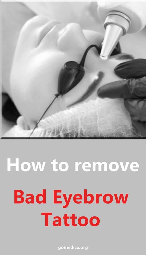 eyebrow tattoo removal Bad Eyebrow Tattoo, Faded Eyebrows, Eyebrow Tattoo Removal, Permanent Eyebrow Tattoo, Tattoo Eyebrows, Eyebrow Tattoos, Bad Eyebrows, Bad Tattoos, Microblading Eyebrows