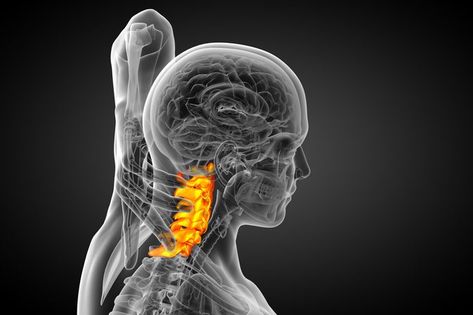 Exercises for Cervical Spondylosis With Foraminal Stenosis Exercises For Cervical Stenosis, Cervical Spine Exercises, Foraminal Stenosis, Stenosis Exercises, Neck Pain Exercises, Nervus Vagus, Cervical Disc, Neck And Shoulder Exercises, Cervical Spondylosis