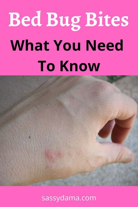 Bed bug bites can be very itchy, annoying, and embarrassing! Here are ways you can identify, prevent, and control bed bugs in your home. Bed Bug Bites Remedies, Bed Bug Bites Pictures, Bed Bugs Essential Oils, Bed Bug Remedies, Bedbugs Removal, Bed Bug Trap, Bug Bites Remedies, Get Rid Of Bed Bugs, Bed Bug Spray