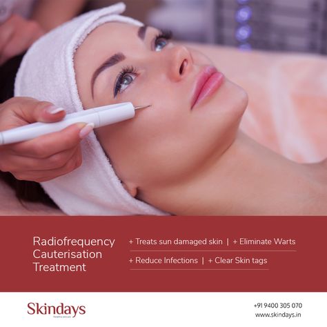 #Radiofrequency #cauterization can permanently remove small & large #skinlesions & #skingrowth . #dermato   #lesion   #radiowaves   #Warts    #skintags   #skintagremoval   #agespots    #angioma   #cherryangioma  #syringoma    #milia    #molluscum   #bestresults   #skincondition     #skintreatment   #skindisease   #skinproblems      #skindoctor   #esthetician   #cosmetologist     #wartsremoval   #electrocautery   #cautery    #cauter   #DPN Warts Removal, Skin Lesions, Skin Moles, Turmeric Health, Natural Hair Mask, Skin Growths, Radio Waves, Coconut Health Benefits, Sun Damaged Skin