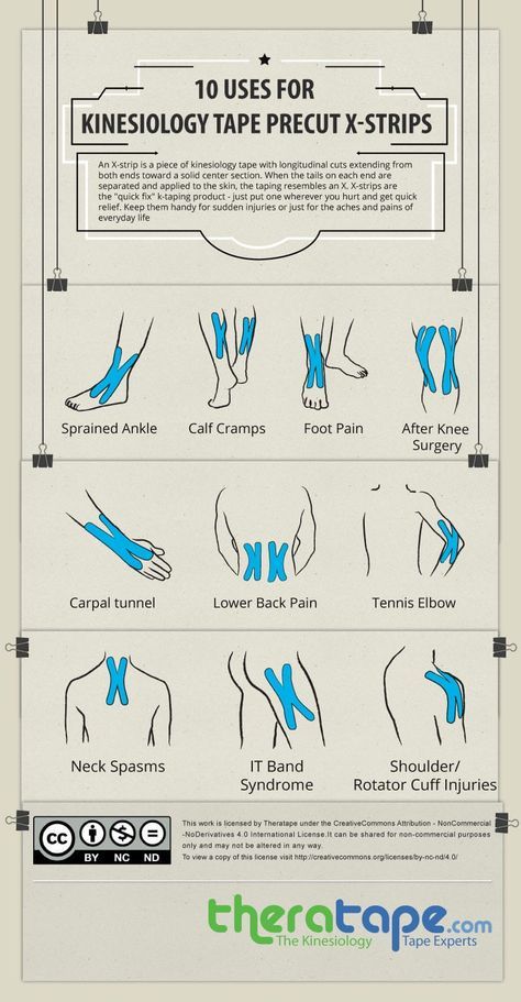 Kinesiology tape X-strips are one of the best types of tape to have in a first aid kit, as they can be applied to any painful area on any part of the body. Get Kinesiology tape X-strips here: http://www.theratape.com/nasara-quickstrips-kinesiology-tape-precut-x-strips.html Kt Tape Volleyball, Neck Spasms, Pnf Stretching, Physio Tape, K Tape, Psoas Release, Calf Cramps, Kinesio Tape, Kt Tape