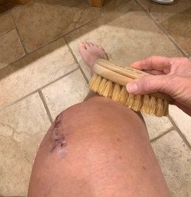 Bus Knee Surgery Recovery, Stool Softener, Scar Cream, Knee Replacement Surgery, What Questions, At The Hospital, Stomach Problems, Knee Surgery, Surgery Recovery