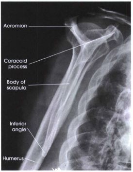 radiographic images of the humerus and shoulder | SCAPULAR Y LATERAL - ANTERIOR OBLIQUE POSITION: SHOULDER (TRAUMA) Shoulder Xray, Rad Tech Student, Radiology Schools, Radiologic Technology, Radiologic Technologist, Radiology Student, Radiology Imaging, Radiology Tech, Surgical Technologist