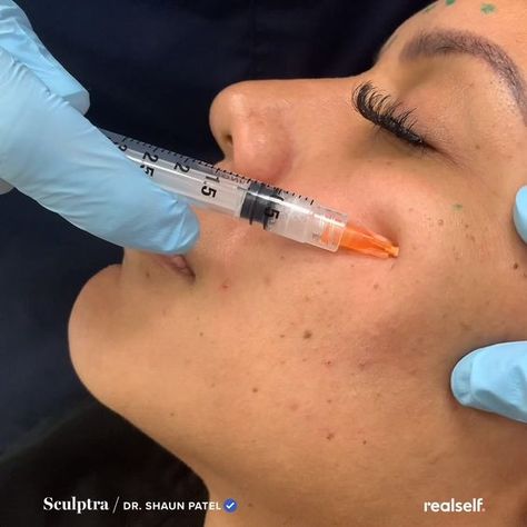 Facial Injections, Collagen Injections, Face Fillers, Botox Lips, Instagram Vs Reality, Hyaluronic Acid Fillers, Botox Cosmetic, Botox Face, Lipstick For Dark Skin