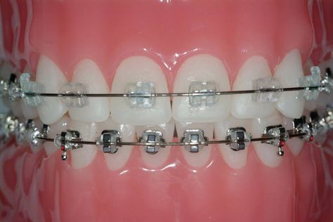 Zenith Skin & Dental Clinic offers all types of teeth braces treatments like invisible braces for teeth, lingual braces,and ceramic braces in Delhi. Braces For Teeth, Behel Gigi, Invisible Teeth Braces, Types Of Teeth, Lingual Braces, Natural Teeth Whitening Diy, Ceramic Braces, Braces Cost, Types Of Braces