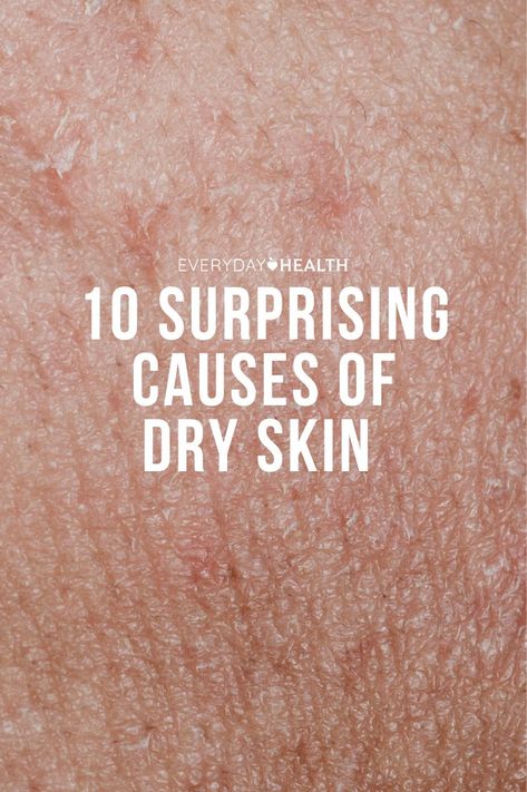 Causes Of Dry Skin, Extra Dry Skin Remedies, Dry Patches On Skin, Itchy Skin Causes, Dry Itchy Skin Remedies, Dry Body Skin, Skin Conditions Pictures, Dry Skin Legs, Dry Skin Home Remedies