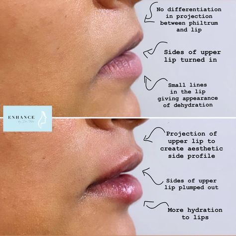 Dʀ Tᴀʀᴀ on Instagram: “A natural looking lip enhancement using 1ml of Teosyal RHA 2 to create more balance in the side profile 👄” Lip Filler Before And After Side Profile, Lip Fillers Side Profile, Lip Filler Side Profile, Heavy Lower Lip, Upper Lip Filler, Natural Looking Lip Fillers, 1 Ml Lip Filler, Lips Side Profile, 1ml Lip Filler