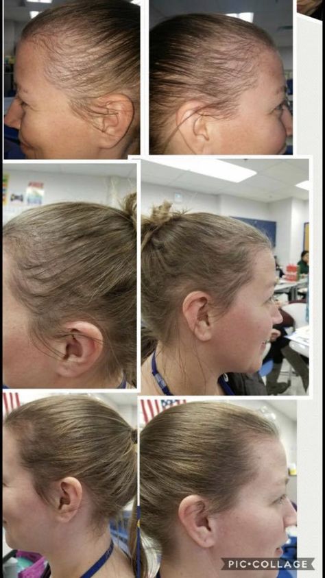 Hair Growth Formula, Hair Fall Solution, Hair Growing Tips, Growth Hair, Monat Hair, Regrow Hair, Home Remedies For Hair, New Hair Growth, Lost Hair