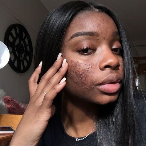 Girl With Acne, Shallow People, Black Skin Care, Brown Spots Removal, Dark Under Eye, Bare Beauty, Pretty Skin, Raw Beauty, Real Beauty