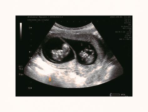 Fraternal Twins Ultrasound, Hasil Usg Kandungan, Usg Kehamilan, Hasil Usg, Twins Ultrasound, Fraternal Twins, Ultrasound Pictures, Hand Pic, Twin Pregnancy