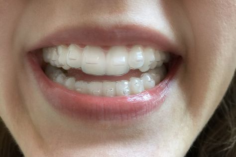 11 Things I Wish I'd Known Before I Got Invisalign Braces Or Invisalign, Invisalign Tips And Tricks, Invisalign Before And After, Invisalign Aesthetic, Invisalign Attachments, Invisalign Tips, After Braces, Zoom Whitening, Braces Cost