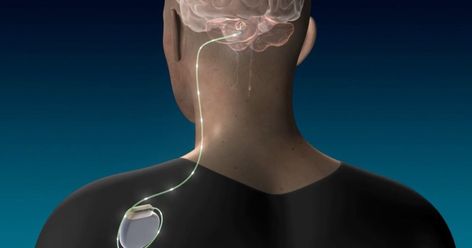 Cleveland Clinic Study Shows Deep Brain Stimulation Encouraging for @TheBrainDriver #tDCS #Creativity #BrainStimulation #PeakPerformance #excellence #SelfImprovement #Stroke Patients – @ClevelandClinic @TheBrainDriver #tDCS #Creativity #BrainStimulation #PeakPerformance #excellence #SelfImprovement https://newsroom.clevelandclinic.org/2023/08/14/cleveland-clinic-study-shows-deep-brain-stimulation-encouraging-for-stroke-patients/ Deep Brain Stimulation, Cerebral Cortex, Physical Rehabilitation, Brain Stimulation, Improve Brain Function, Cleveland Clinic, Neurological Disorders, Human Brain, Brain Function