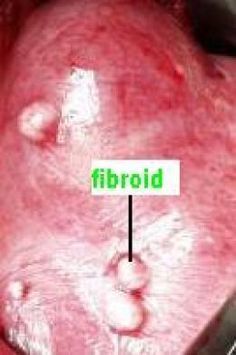 Fibroid Remedies, Female Problems, Food Cleanse, Fibroid Diet, Healing Naturally, Thyroid Remedies, Fibroid Surgery, Fibroid Tumors, Everyday Health