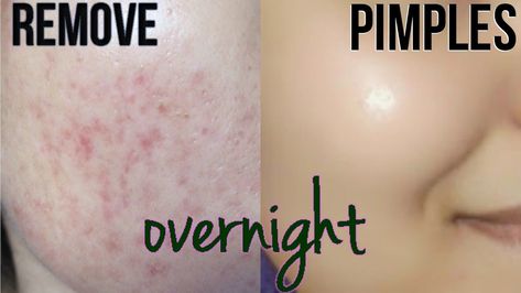 Remove Pimples Overnight, To Remove Pimples, Remove Pimples, Acne Overnight, Pimples Overnight, Skin Care Routine For 20s, Natural Acne, How To Get Rid Of Pimples, Acne Scar