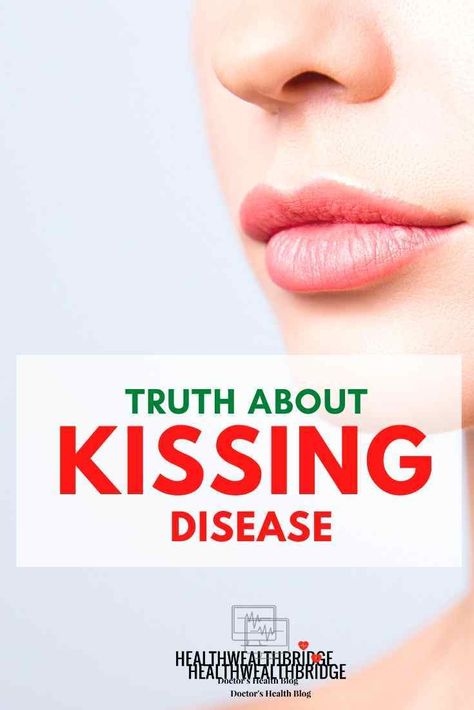 Kissing Disease, Enlarged Liver, Epstein Barr, Throat Pain, Facial Nerve, Holistic Health Remedies, Holistic Health Coach, Health Inspiration, The Kiss