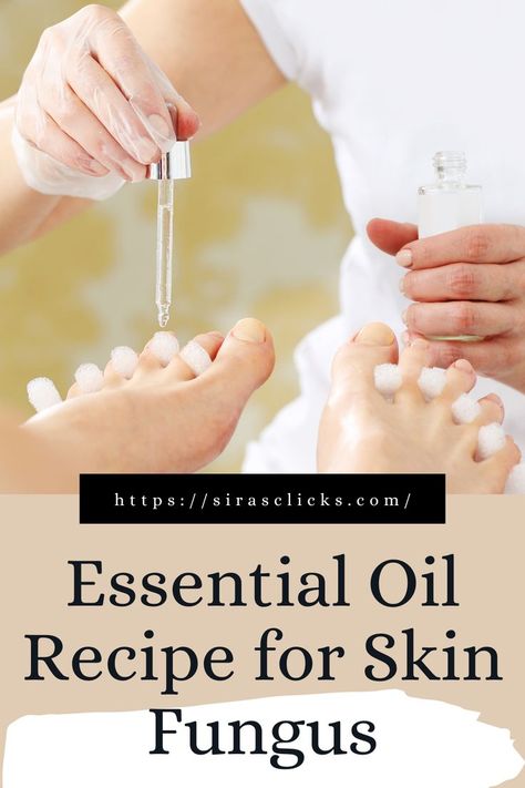 Best Essential Oils For Skin, Antifungal Essential Oil, Fungi Recipe, Skin Fungus, Essential Oil Spray Recipes, Nail Remedies, Natural Antifungal, Thyme Essential Oil, Nail Fungus Remedy