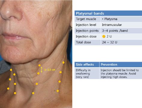 Figure 17 from Consensus recommendations on the aesthetic usage of botulinum toxin type A in Asians. | Semantic Scholar Platysmal Band Botox Before And After, Toxin Injection, Platysmal Bands, Botox Injection Sites, Aesthetic Treatments, Facial Aging, Facial Scars, Hyaluronic Acid Fillers, Facial Anatomy