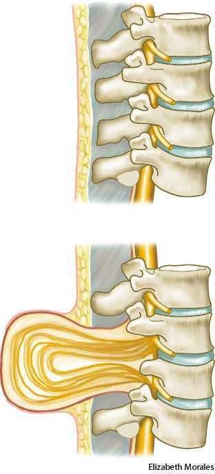 Medical Ultrasound, Spinal Column, Spina Bifida, Wheelchair Accessories, Dictionary Definitions, Medical Anatomy, Neurological Disorders, Spinal Cord, Scientific Illustration