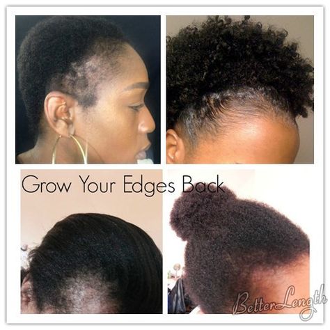 Traction Alopecia Regrowth, No Edges Hairstyles Black Women, Black Hair Edges, Hair Thickening Remedies, Thinning Edges, Traction Alopecia, Scalp Conditions, Soften Hair, Oil Treatments