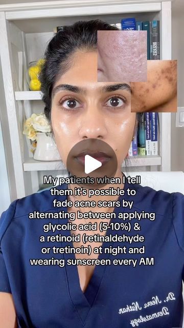 Dr. Neera Nathan on Instagram: "Combining glycolic acid and retinoids has been shown in clinical studies to fade acne scars and marks and is one of the few topical treatments that have shown efficacy when used nightly. This combination helps to renew skin cells and stimulate collagen synthesis, which in turn can fade pigmentation and fill in scars. Using both actives on the same night can be irritating, especially for beginners, so I recommend alternating these actives by starting to use each 2x per week and then working up to nightly, if tolerated. Look for glycolic acid 6-10% and retinaldehyde 0.05% - 0.1% (over the counter) or tretinoin 0.025% (Rx). Glytone makes a combination glycolic acid/retinoid product (Night Renewal Cream) that can be used once nightly (as tolerated). Wearing suns Tretinoin Before And After Acne, Skincare Reels, Acne Scar Cream, Natural Body Care, Glycolic Acid, Natural Body, Skin Protection, Skin Cells, Face And Body