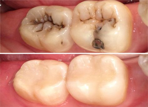 Looking for best composite restorations in Delhi? Visit here for complete information. Happy Dental, Composite Fillings, Dental Pictures, Dental Wallpaper, Dental Composite, Tooth Filling, Dental Posters, Dental Anatomy, Dental Fillings