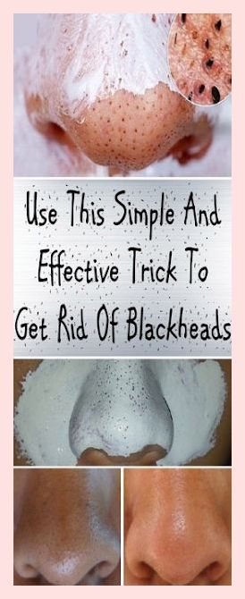 This is a Uncommon information! Homemade Medicine, Get Rid Of Blackheads, Fat Removal, Healthy Beauty, Lose 40 Pounds, Skin Tips, Blackhead Remover, Blackheads, Oily Skin