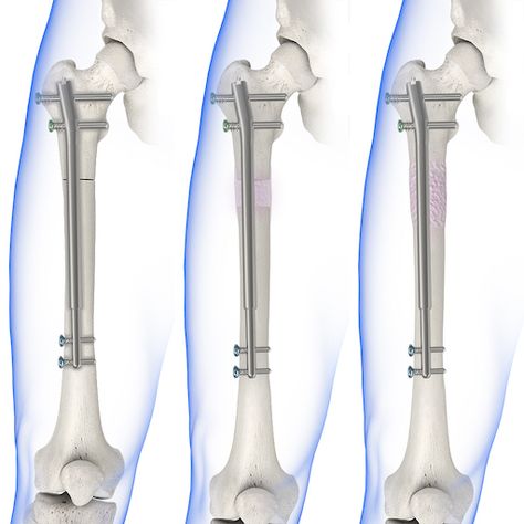 Limb Lengthening Surgery, Leg Lengthening Surgery, Limb Lengthening, Cool Prosthetics Limbs, Medicine Anatomy, Bow Legged Correction, Laparoscopic Surgery Instruments, Orthotics And Prosthetics, Ovarian Cystectomy