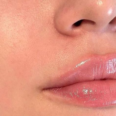 Dr.Shiva Zahed on Instagram: "Art should speak for itself without artist statements! 

1 ml stylage filler for lips in this case.

Technique : same natural lips with extra volume and lift 
Anesthetic: local num 
Pain : low
Time : 15 min 
Edema :7 days 
Permanent: 12 months 

25% of the filler first month will absorb and any kind of asymmetrical will be solved in retouching after 2 weeks.

#filler #lipfiller #natural #doctor #cosmetics #stylage #stylagelips #istanbuldoctors #dubai" Lip Fillers, Artist Statement, Natural Lips, Instagram Art, Shiva, 12 Months, Dubai, Lips, Quick Saves