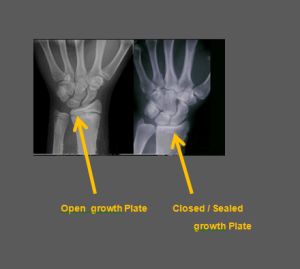 When and why the growth/ epiphyseal plates close – GTWSL Epiphyseal Plate, Height Exercise, Increase Height Exercise, Estrogen Hormone, Height Growth, Pituitary Gland, Plant Tissue, Animal Study, Hormone Levels