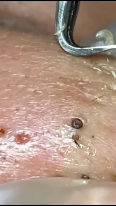 Pimple Extraction Videos, Acne Popping, Pimple Poppìng, Black Heads Removal Video, Pimple Extraction, Best Dark Spot Corrector, Pore Cleaning, Home Remedies For Pimples, Zits Popping