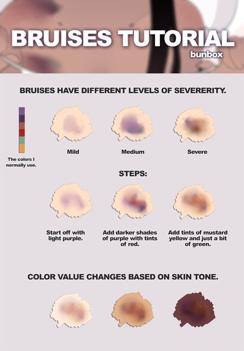 drawingden: “Bruises Tutorial by Bunsiebox ” How To Draw A Wound, Tips For Drawing Gore, Burnt Skin Drawing, Injury Art Reference, How To Draw Bruising, Bruising Reference, How To Draw Gore Tutorial, How To Draw Injuries, Art References Blood