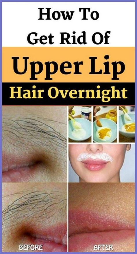 Natural Hair Removal Remedies, Electrolysis Hair Removal, Upper Lip Hair, Natural Hair Removal, Home Medicine, Remove Unwanted Hair, Unwanted Facial Hair, Facial Hair Removal, Hair Removal Permanent