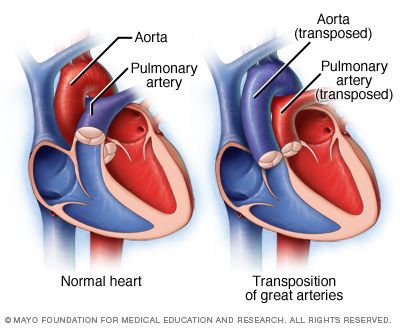 Transposition of great vessels. Positions of the aorta and the pulmonary artery are reversed. Transposition Of The Great Arteries, Digeorge Syndrome, Patent Ductus Arteriosus, Cardiothoracic Surgery, Mitral Valve, Normal Heart, Congenital Heart, Heart Defect, Congenital Heart Defect