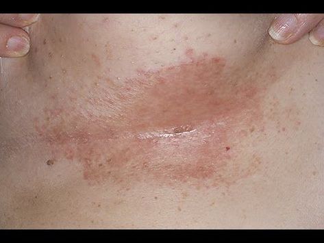 A breast rash is the irritation and redness that usually occurs on the skin under the breasts. Breast rash may occur as a result of wearing a bra that doesn't fit well or excessive sweating below the breasts. A breast rash may present... Home Remedies For Rashes, Rash Remedies, Fungal Rash, Rashes Remedies, Yeast Infection Causes, Red Rash, Heat Rash, Health Topics, Breast Health