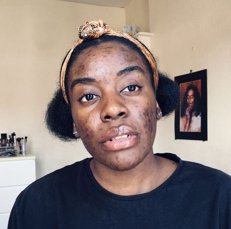 🔸Journey To Clear Skin🔸 Just a photo to show my skin concerns (active acne, hyperpigmentation and post inflammation and oily skin) Yikkes lol #skincare #hyperpigmentation #acne #oilyskin Embracing Acne, Skincare Hyperpigmentation, Girl With Acne, Acne Positivity, Hyperpigmentation Black Skin, Acne Women, Hair And Skin Vitamins, Human Skin Color, Braids Styling