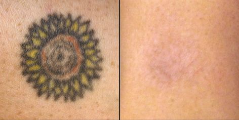 Natural Tattoo Removal: How To Remove Tattoos Naturally? #tattooremovalnatural At Home Tattoo Removal, Tattoo Eraser, Picosure Tattoo Removal, Natural Tattoo Removal, Tattoo Removal Cream, Tattoo Removal Cost, Faded Tattoo, Tattoo Diy, Tattoo Cream