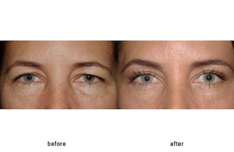 Eyelid Lift Before After, Hooded Eye Surgery Before And After, Upper Eye Lid Surgery Before And After, Upper Eyelid Lift Surgery, Eye Lid Surgery Before And After, Botox For Hooded Eyelids, Hooded Eye Surgery, Eye Lift Surgery, Epicanthic Fold