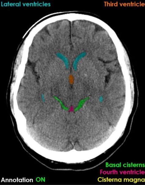 Ct Scan Brain, Ct Brain, Medical Textbooks, Brain Images, Brain Anatomy, Ct Scan, Radiology, The Brain, Image Gallery