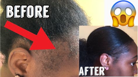 Hairstyles For No Edges Black Women, No Edges Hairstyles Black Women, African American Hair Growth, Hair Latina, Hair Growth Charts, Alopecia Treatment, Alopecia Hairstyles, Best Hair Growth, Natural Hair Growth Remedies