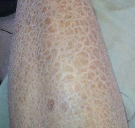 Secondary Skin Lesions | Concise Medical Knowledge Rare Skin Conditions, Secondary Skin, Tinea Pedis, Skin Lesions, Integumentary System, Subcutaneous Tissue, Fish Skin, Sweat Gland, Skin Dryness