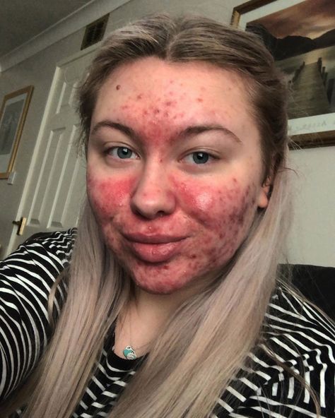 Abigail now feels confident enough to leave the house without any makeup on Makeup On Acne, Girl With Acne, Back Acne Remedies, Acne Makeup, Bad Acne, Acne Overnight, Flaking Skin, No Makeup Makeup, Natural Acne Remedies