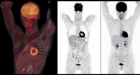 Nuclear imaging scan showing very good tissue delineation. Scan performed on a Biograph Vision positron emission tomography/computed tomography (PET-CT) system from Siemens Healthineers. Siemens Healthineers, Computed Tomography, Pet Ct, Radiology Imaging, Pet Scan, Ct Scan, Art Science, Visible Light, Radiology