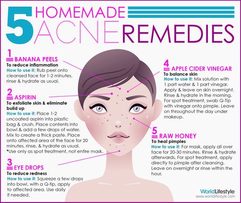 %|%Infographic%|% Writer: Christina Marrale; Designer: Leah Freeman-Haskin Read the text version of the 5 DIY Acne Remedies infographic here. Homemade Acne Remedies, Cystic Acne Remedies, Skin Care Routine For 20s, Diy Acne, Get Rid Of Acne, Rid Of Acne, Natural Acne Remedies, Natural Acne, Home Remedies For Acne