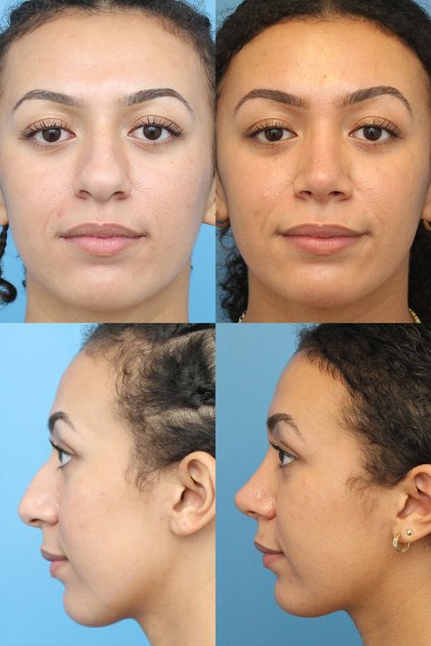 Rhinoplasty Surgery Before and After | Ranch & Coast Plastic Surgery Liquid Rhinoplasty Before And After, Bulbous Nose Rhinoplasty Before After, Kpop Plastic Surgery, Nose Rhinoplasty, Jaw Reduction Surgery, V Line Surgery, Crooked Nose, Bulbous Nose, Plastic Surgery Fail