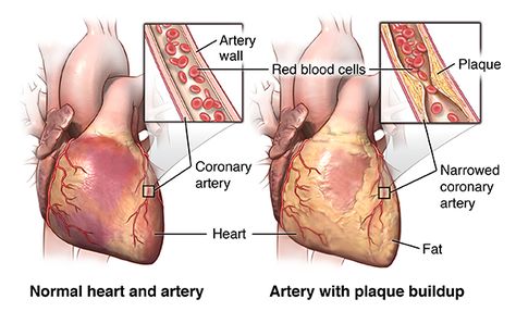 CABG is used to treat coronary artery disease in certain circumstances. Learn more about the procedure and what to expect before during and after surgery. Angina Pectoris, Heart Valves, Normal Heart, Open Heart Surgery, Bypass Surgery, Heart Muscle, Coronary Arteries, Heart Surgery, Snacks Für Party