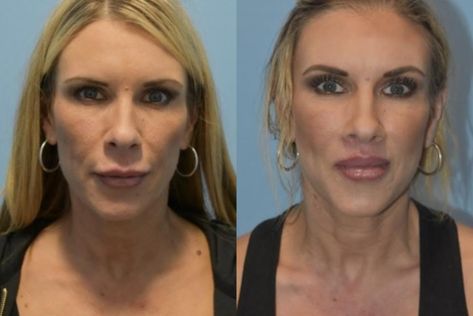 Lip Lift Surgery Before And After, Lip Lift Before And After, Lip Lift Surgery, Lip Implants, Lip Lift, Botox Cosmetic, Facial Surgery, Facial Plastic Surgery, Facial Plastic