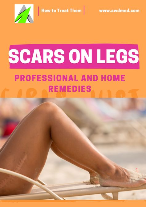 Dark Spots On Legs How To Get Rid Of, Dark Scar Removal On Legs, How To Remove Marks From Legs, Dark Spots On Legs Remove Diy, How To Remove Burn Marks On Skin, Dark Marks On Legs How To Get Rid Of, Dark Spots On Body How To Remove, Scar Fading Remedies, Scar Removal Remedies Leg