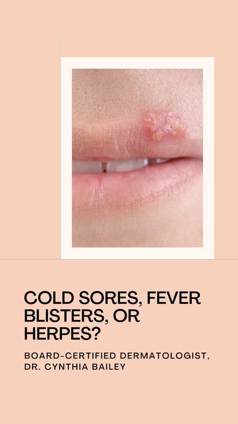 text: Cold Sores, Fever Blisters, or Herpes? image of cold sore. Fever Blister Remedy Fast, Fever Blister Causes, Cold Sore Remedy Overnight, Sun Blisters, Fever Blister Remedy, Blister Remedies, Home Remedies For Fever, Hangover Headache, Tea Tree Oil Benefits