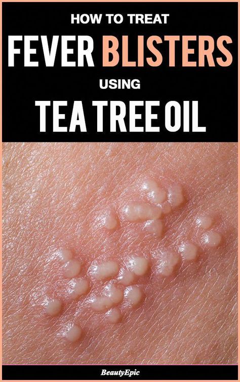 Simple Methods Of Using Tea Tree Oil for Fever Blisters #coconutoilfordarkspots Castor Oil For Acne, Tea Tree Oil Benefits, Tea Tree Oil Uses, Tea Tree Oil Face, Oils For Dandruff, Tea Tree Oil For Acne, Fever Blister, Essential Oils For Headaches, Cold Sores